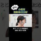 脂肪吸引注射ってどれくらい取れるの？ #美容整形 #脂肪吸引