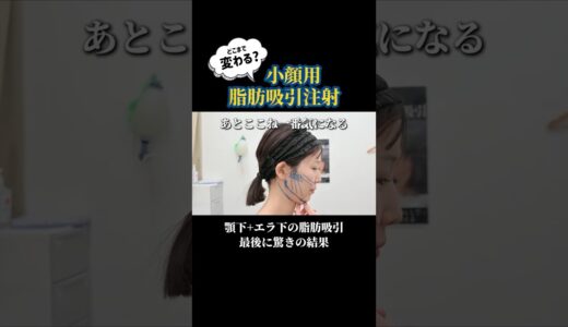 脂肪吸引注射ってどれくらい取れるの？ #美容整形 #脂肪吸引
