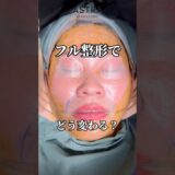フル整形でどう変わる？🥹🥹#astrabeautyclinic  #アストラビューティークリニック #塩満恵子 #鼻整形 #美容整形 #忘れ鼻