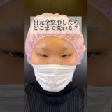 【目元整形】#shorts 目元全整形でどう変わる？