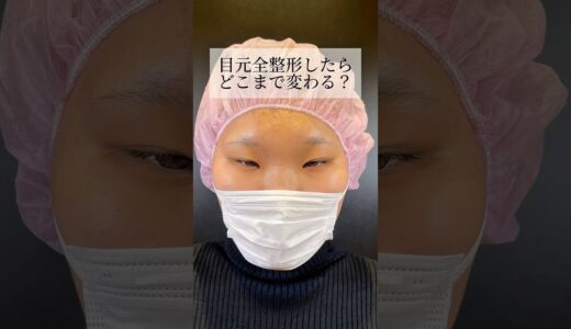 【目元整形】#shorts 目元全整形でどう変わる？