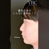 【衝撃】鼻先だけでこの変化！#鼻整形 #美容整形 #整形 #人気