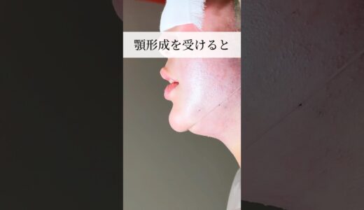 【美容整形】顎形成受けたら…#shorts