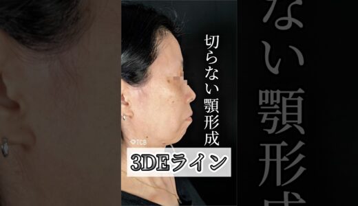 【美容整形】横顔美人になるには⁉️#shorts
