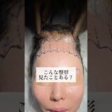 【整形】こんな整形みたことある？#shorts