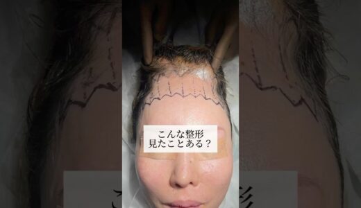 【整形】こんな整形みたことある？#shorts