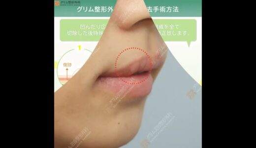 傷跡綺麗ってタイミングがあるの？#韓国美容整形　#グリム整形外科　#傷跡　#修正手術　#口元　#唇　#レーザー治療　#渡韓整形 #口唇口蓋裂　#人中短縮