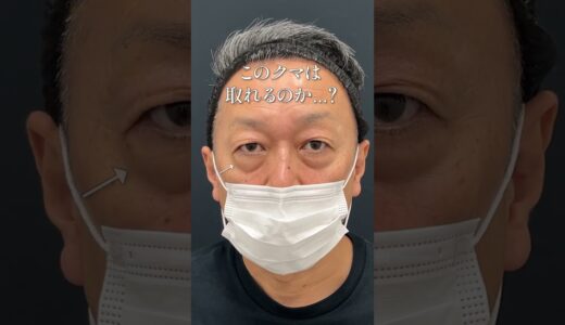 このクマは取れるのか…？ #湘南美容クリニック名古屋院 #美容整形 #クマ取り