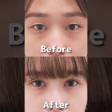 #美容 #美容整形 #埋没法 #二重埋没 #埋没