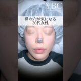 【鼻整形】コンプレックスから卒業しませんか？#美容整形 #整形 #鼻整形