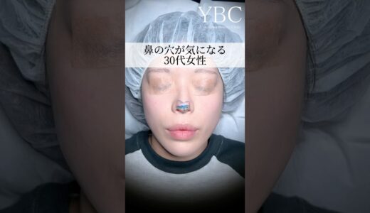 【鼻整形】コンプレックスから卒業しませんか？#美容整形 #整形 #鼻整形