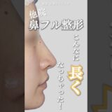 鼻フル整形、こんなに長くなっちゃった？！　#鼻整形 #美容整形 #他院修正 #小鼻縮小 #shortvideo #新宿山本クリニック #鼻尖形成 #鼻中隔延長 #修正地獄 #鼻フル #shorts