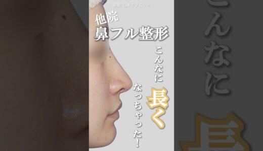 鼻フル整形、こんなに長くなっちゃった？！　#鼻整形 #美容整形 #他院修正 #小鼻縮小 #shortvideo #新宿山本クリニック #鼻尖形成 #鼻中隔延長 #修正地獄 #鼻フル #shorts