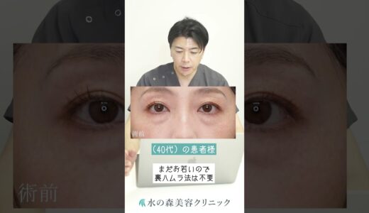 最適なクマ取り治療は？#shorts #水の森美容クリニック #美容整形 #若返り治療 #クマ治療#クマ取り ＃ハムラ法＃裏ハムラ法