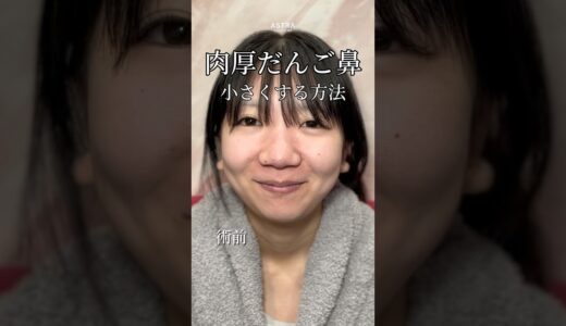 【肉厚だんご鼻を鼻フル整形で忘れ鼻へ✨#忘れ鼻#鼻整形#美容整形#だんご鼻#団子鼻#塩満先生#アストラビューティークリニック#astrabeautyclinic#渋谷】