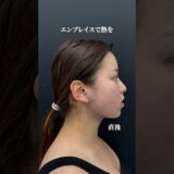【小顔整形】いらない脂肪を排除し、額・こめかみに注入したことで卵輪郭に！ #shorts