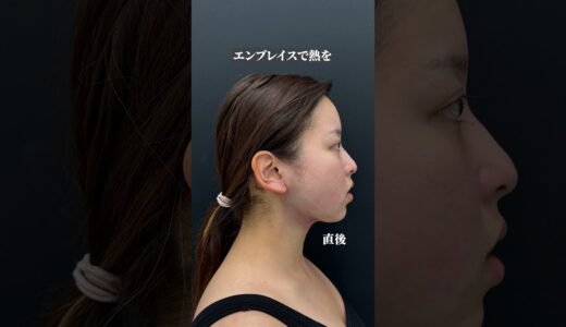 【小顔整形】いらない脂肪を排除し、額・こめかみに注入したことで卵輪郭に！ #shorts