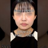 顔になりたくて本気出した結果　#美容 #整形 #脂肪吸引 #糸リフト #ボトックス