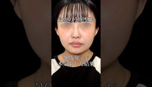 顔になりたくて本気出した結果　#美容 #整形 #脂肪吸引 #糸リフト #ボトックス