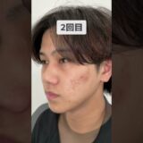 【ニキビ・ニキビ跡】大人気肌治療ポテンツァ経過をご紹介！ #美容整形 #整形 #ニキビ跡 #肌荒れ