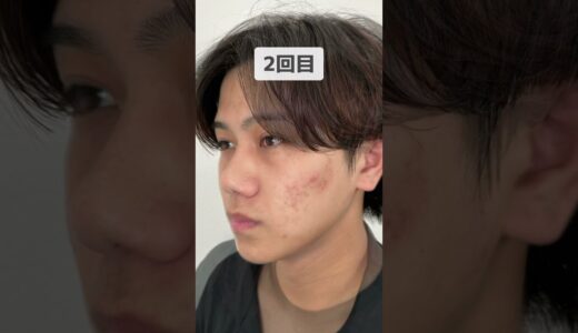 【ニキビ・ニキビ跡】大人気肌治療ポテンツァ経過をご紹介！ #美容整形 #整形 #ニキビ跡 #肌荒れ