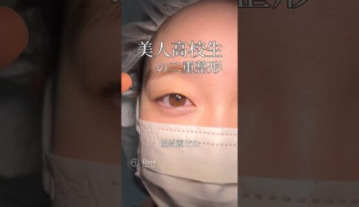 【二重整形】高校生で二重整形、あり？なし？#shorts