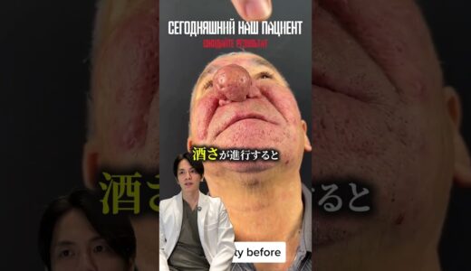 【衝撃】鼻が大きくなる病！？ #shorts  #美容整形
