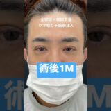 30代メンズの眼瞼下垂＋クマ取り。人生変わるレベルの変化です。