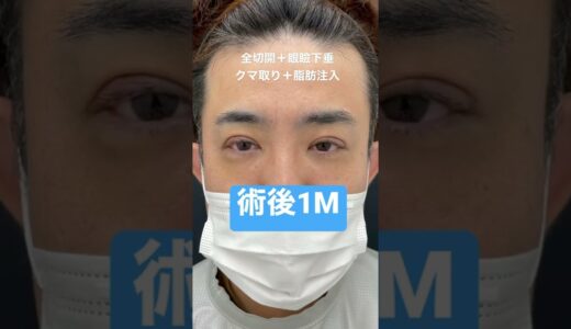 30代メンズの眼瞼下垂＋クマ取り。人生変わるレベルの変化です。