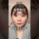 鼻整形でどう変わる？😃💖#astrabeautyclinic  #アストラビューティークリニック #塩満恵子 #鼻整形 #美容整形 #忘れ鼻