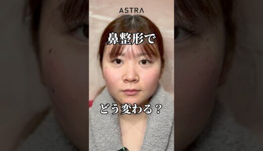 鼻整形でどう変わる？😃💖#astrabeautyclinic  #アストラビューティークリニック #塩満恵子 #鼻整形 #美容整形 #忘れ鼻