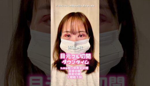 目フル整形のダウンタイム全部見せ！#美容整形 #目元切開#全切開二重術 #目頭切開 #目尻切開