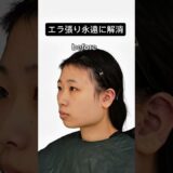 【エラを削るとこんなに変わる】#エラ #アーククリニック＃美容整形#ロゴボ#骨切り ＃セットバック#横顔美人＃輪郭 #輪郭形成  #オトガイ形成 #小顔整形