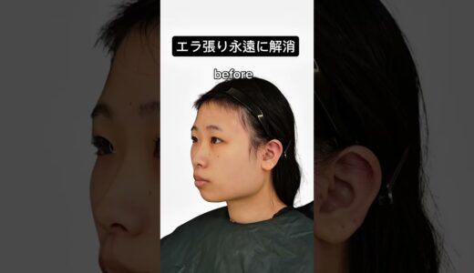 【エラを削るとこんなに変わる】#エラ #アーククリニック＃美容整形#ロゴボ#骨切り ＃セットバック#横顔美人＃輪郭 #輪郭形成  #オトガイ形成 #小顔整形
