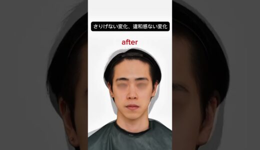 【さりげない変化、違和感ない変化】#アーククリニック＃美容整形#ロゴボ#骨切り ＃セットバック#横顔美人＃輪郭 #輪郭形成  #オトガイ形成 #小顔整形