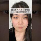 親に断られた二重整形…1ヶ月後の結果は？！#shorts #二重整形 #二重埋没 #整形 #美容整形 #東京 #池袋