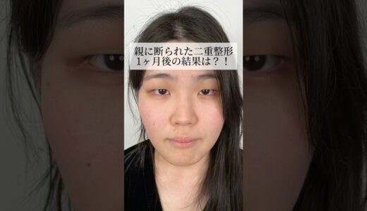 親に断られた二重整形…1ヶ月後の結果は？！#shorts #二重整形 #二重埋没 #整形 #美容整形 #東京 #池袋