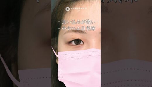 まるで生まれつきの二重！？　#二重埋没 #美容 #整形 #美容整形 #東京形成美容外科