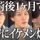 【美容整形版 令和の虎】両顎手術後のたるみを解消させます。