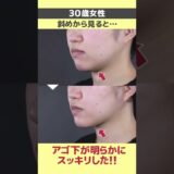 【HIFU/ハイフ】効果がないと思ってる方は見て！【湘南美容クリニック】#Shorts