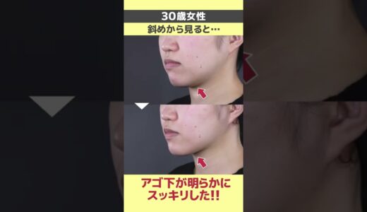 【HIFU/ハイフ】効果がないと思ってる方は見て！【湘南美容クリニック】#Shorts