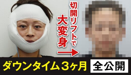 【切開リフト】ガチでつらい？リアルなダウンタイムに完全密着【水の森美容クリニック／MACSリフト・フェイスリフト】