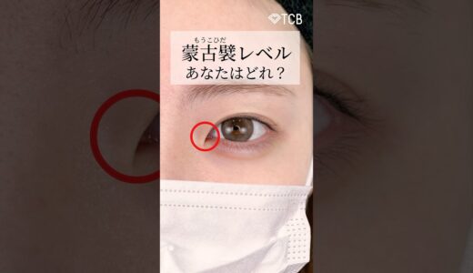 【美容整形】蒙古襞レベルあなたはどれ？#shorts