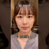 自然癒着整形 直後 vs 1ヶ月後…こんなに変わる？#shorts