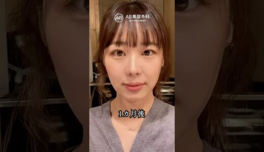 自然癒着整形 直後 vs 1ヶ月後…こんなに変わる？#shorts