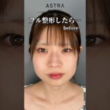 全顔フル整形で･･･😧💖#astrabeautyclinic  #アストラビューティークリニック #塩満恵子 #鼻整形 #美容整形 #忘れ鼻
