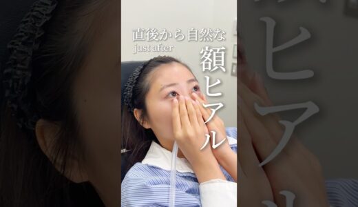 流行りのバブみおでこ♡額ヒアルで垢抜け　#額ヒアル #ヒアルロン酸