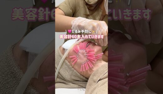 たるみ予防に美容針60本❣️#たるみ改善 #美容整形 #美容クリニック