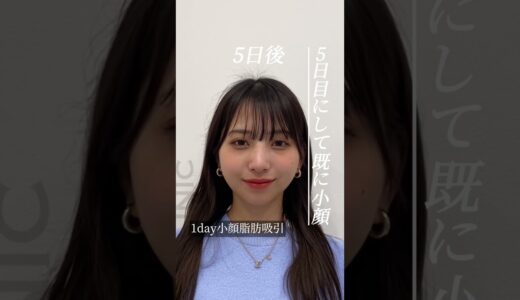 【ダウンタイム大公開】1day小顔脂肪吸引のダウンタイム大公開！ #柴田先生 #shorts