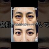 脱脂オンリーはNGな例を説明します。目の下のクマ取りたるみ取り美容整形 予約は☎️0120489100 #美容整形#目の下のたるみ#目の下のくま#くまとり#クマ取り#目の下のクマ#shorts